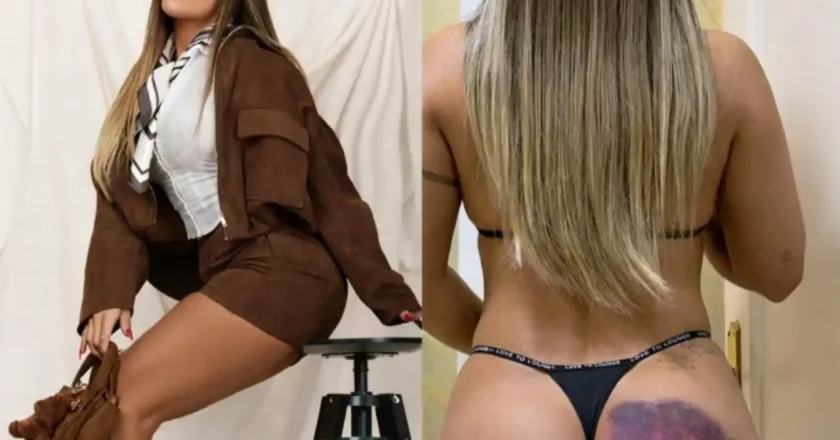 Ex-Miss Bumbum sofre queda em escada e acredita que seu bumbum evitou ferimentos sérios